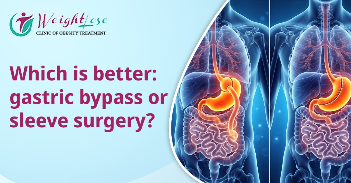 Which is better: gastric bypass or sleeve surgery?